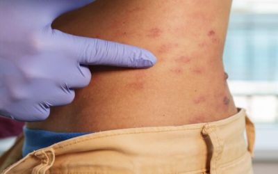 Ako liečiť atopickú dermatitídu: sprievodca svetelnou terapiou